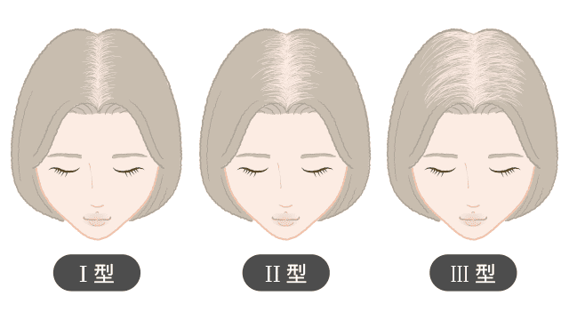 FAGA（女性男性型脱毛症）