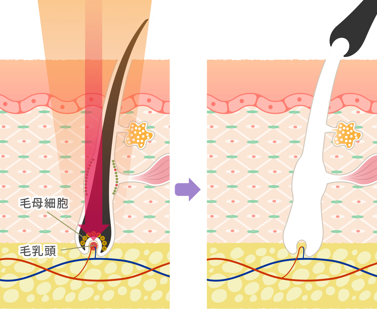 医療脱毛の仕組み