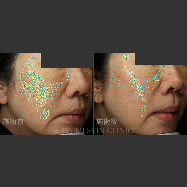 プロファイロ　症例写真