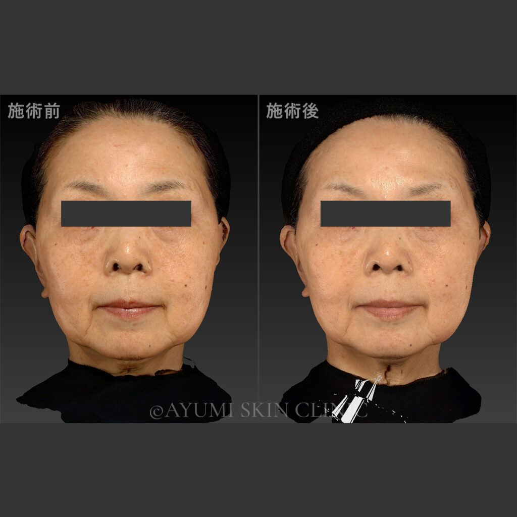 スキンボトックス　症例写真
