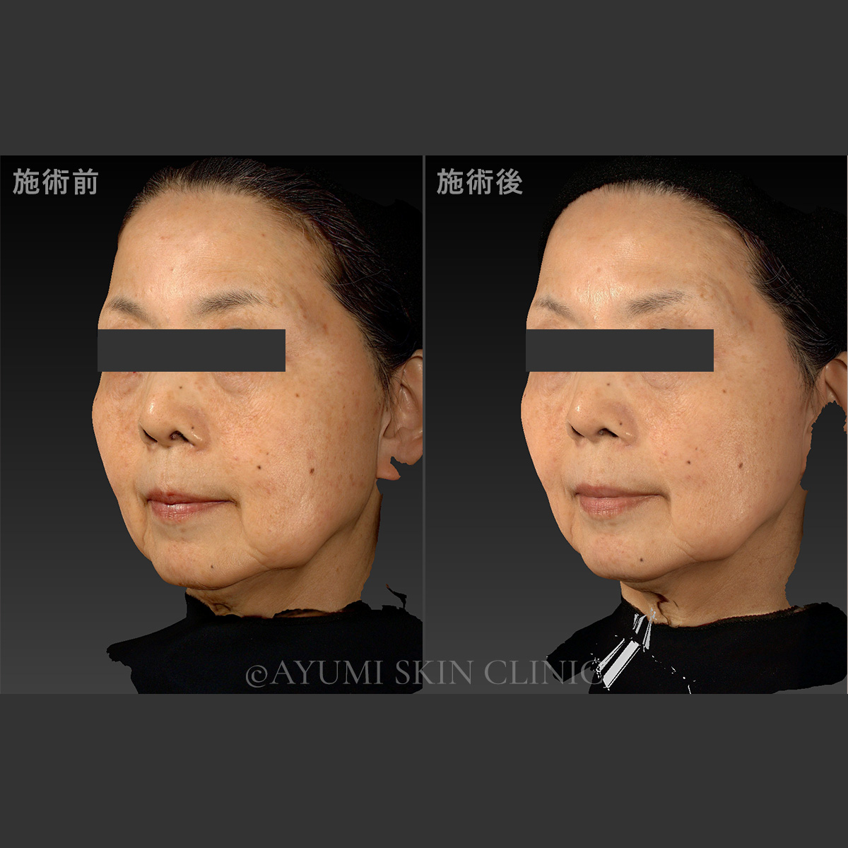スキンボトックス　症例写真