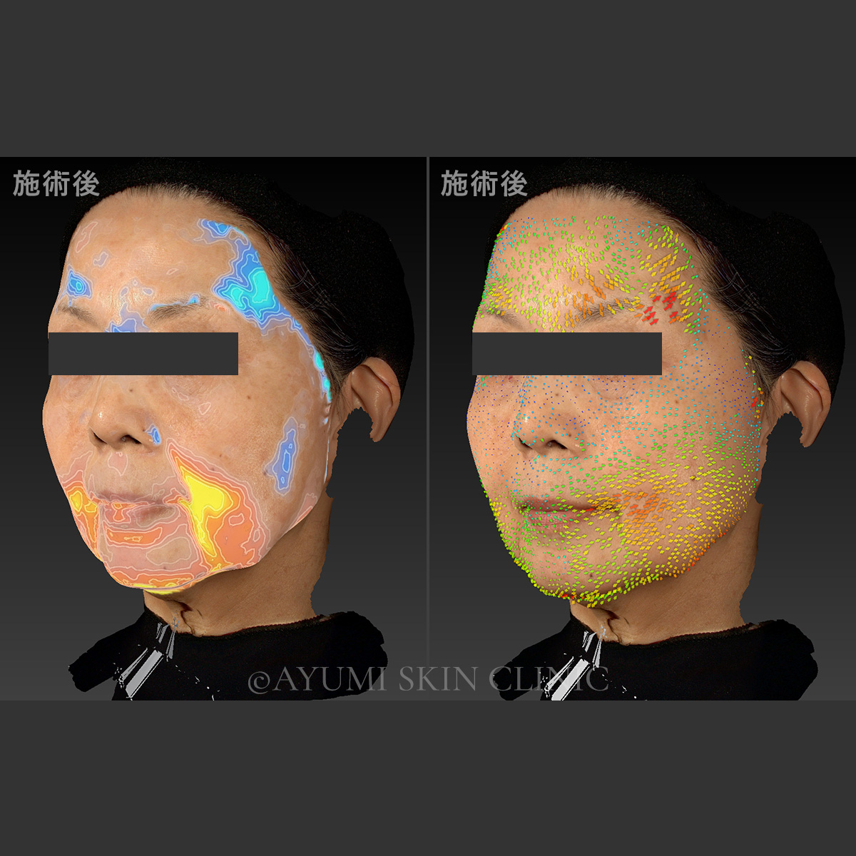 スキンボトックス　症例写真