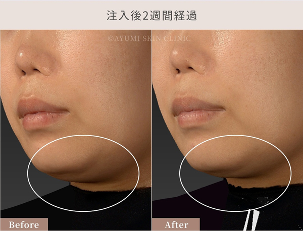 脂肪溶解注射×ボルニューマー×ハイフ｜熊本市の美容皮膚科 AYUMI SKIN CLINIC