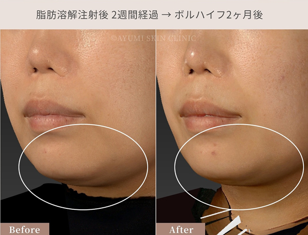 脂肪溶解注射×ボルニューマー×ハイフ｜熊本市の美容皮膚科 AYUMI SKIN CLINIC