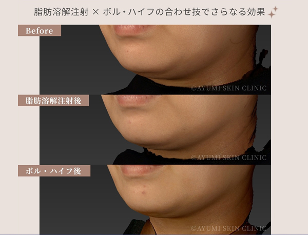 脂肪溶解注射×ボルニューマー×ハイフ｜熊本市の美容皮膚科 AYUMI SKIN CLINIC