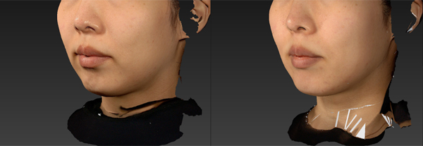 ボルニューマー施術例｜熊本市の美容皮膚科 AYUMI SKIN CLINIC