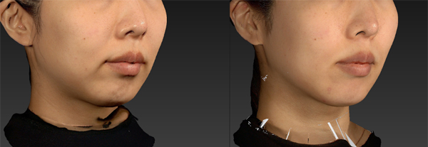 ボルニューマー施術例｜熊本市の美容皮膚科 AYUMI SKIN CLINIC