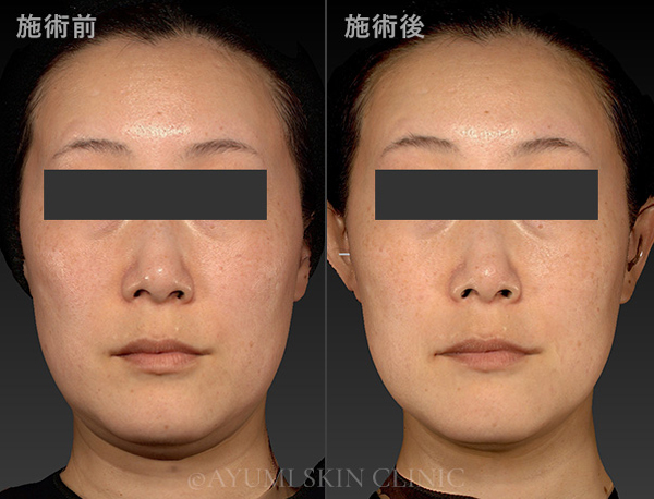 ボルニューマー×ハイフ施術例｜熊本市の美容皮膚科 AYUMI SKIN CLINIC