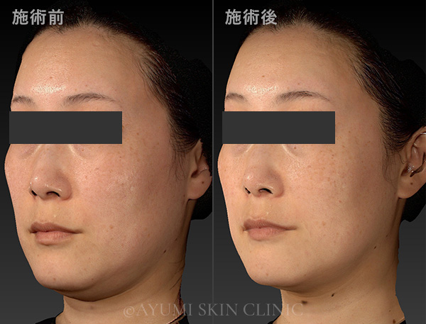 ボルニューマー×ハイフ施術例｜熊本市の美容皮膚科 AYUMI SKIN CLINIC