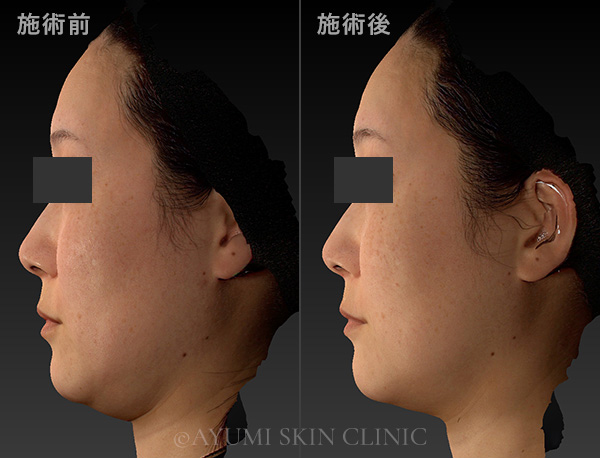 ボルニューマー×ハイフ施術例｜熊本市の美容皮膚科 AYUMI SKIN CLINIC