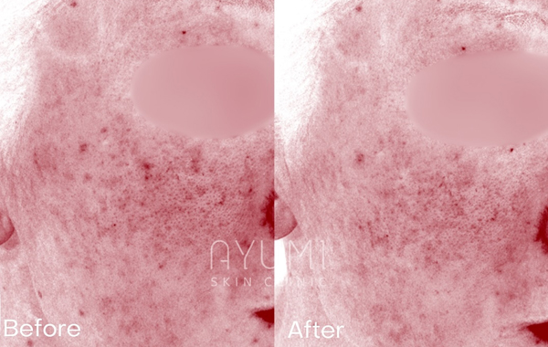 ボルニューマー施術例｜熊本市の美容皮膚科　AYUMI SKIN CLINIC