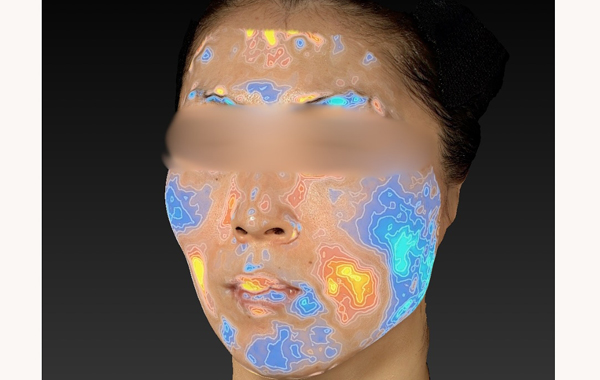 ボルニューマー施術例｜熊本市の美容皮膚科　AYUMI SKIN CLINIC