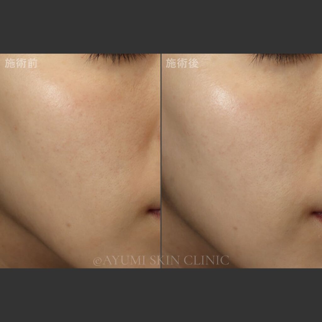 ターゲットクール（プルリアルエクソユース）　症例写真