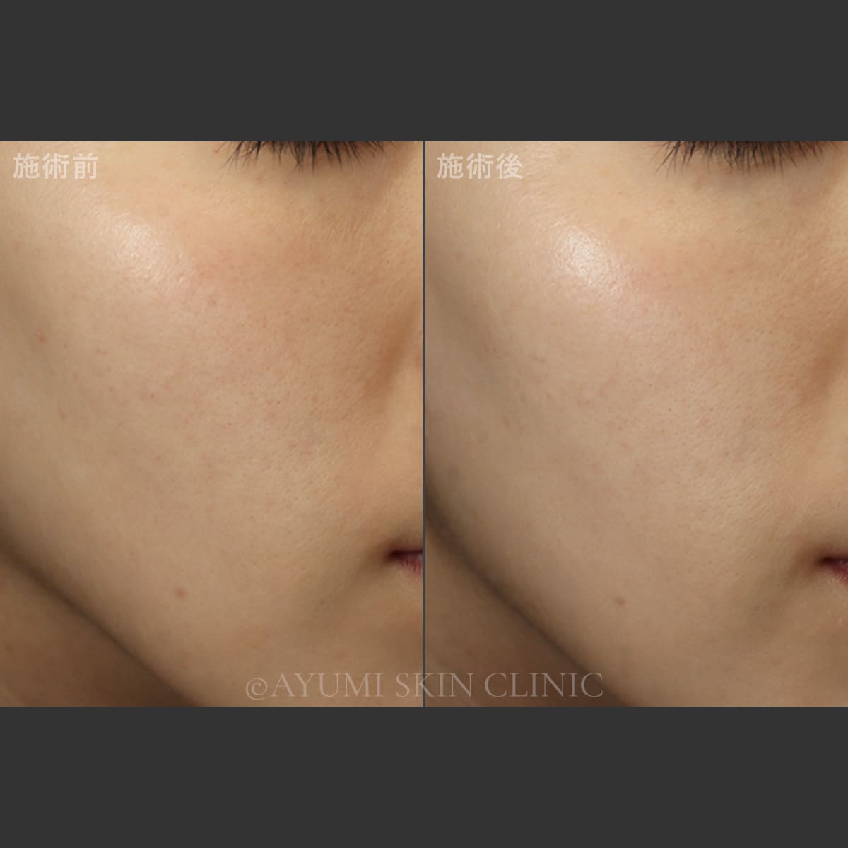 ターゲットクール（プルリアルエクソユース）　症例写真