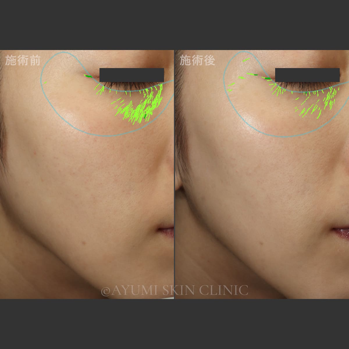 ターゲットクール（プルリアルエクソユース）　症例写真