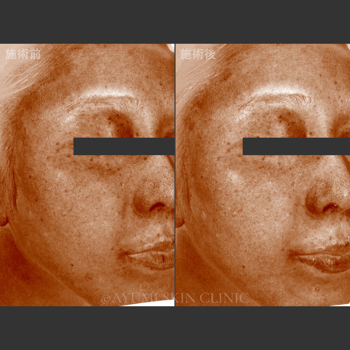 ターゲットクール（プルリアルエクソユース）　症例写真