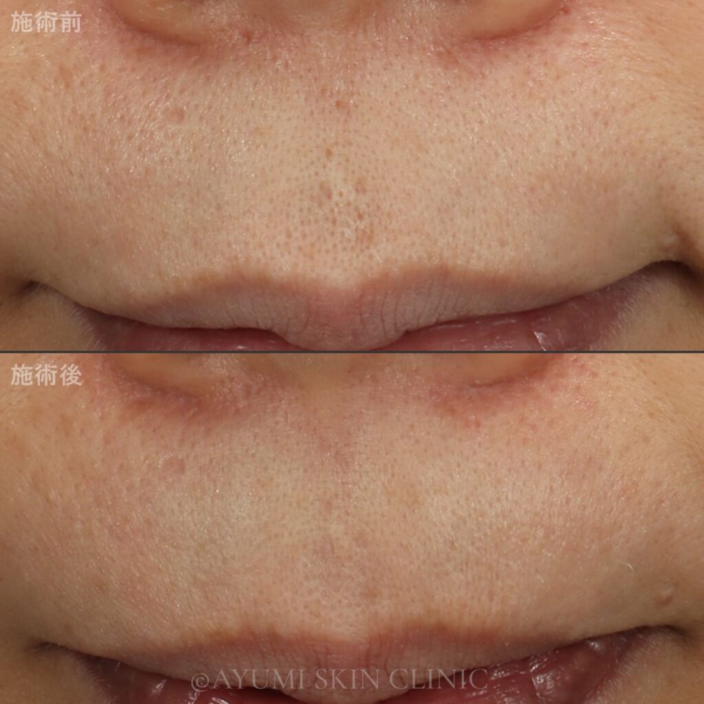 TCAクロス　症例写真