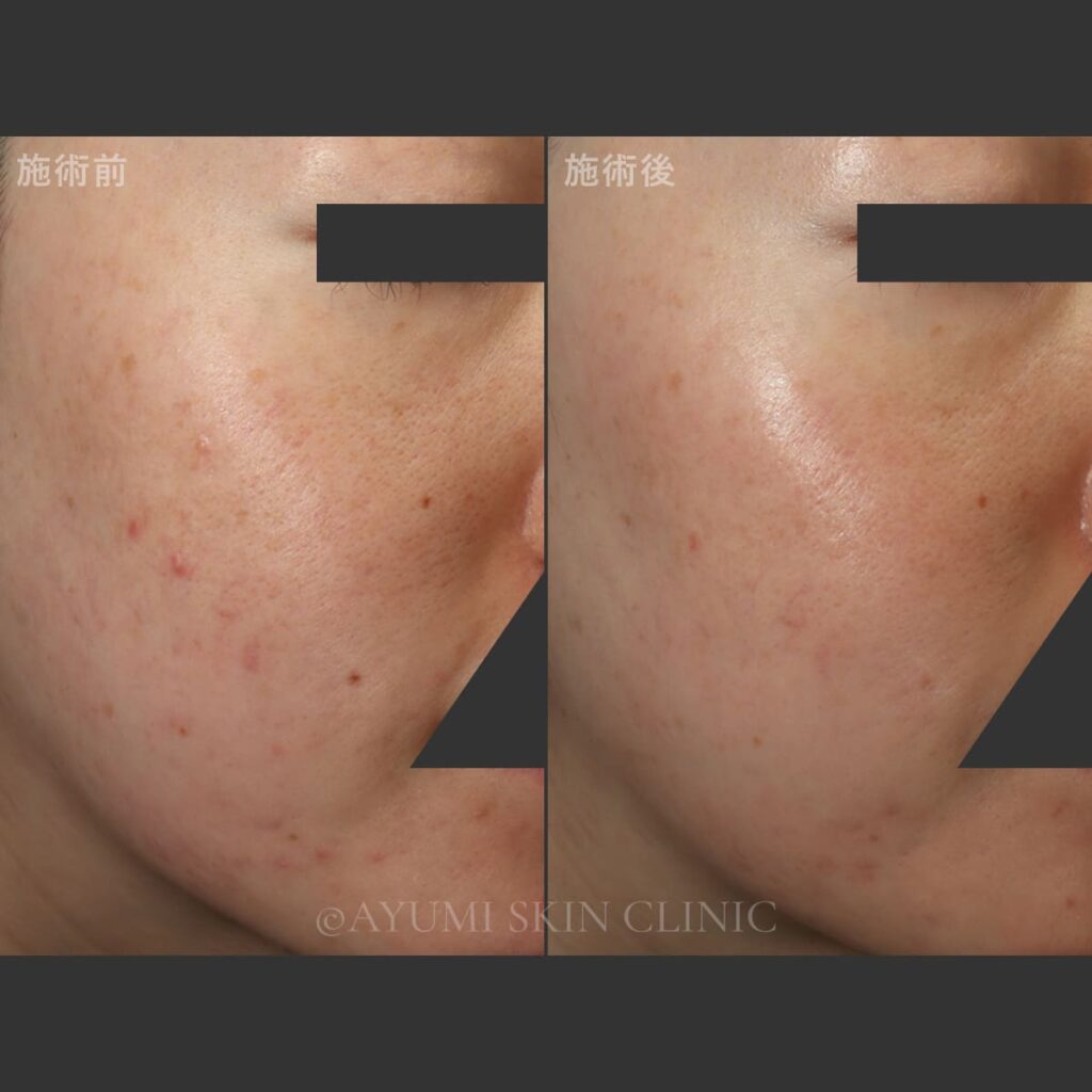 ピーリング＋スプレンダーフェイシャル　症例写真