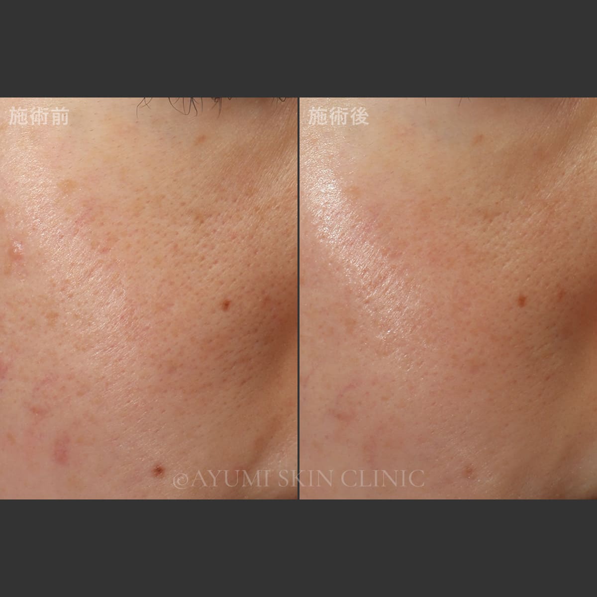 ピーリング＋スプレンダーフェイシャル　症例写真