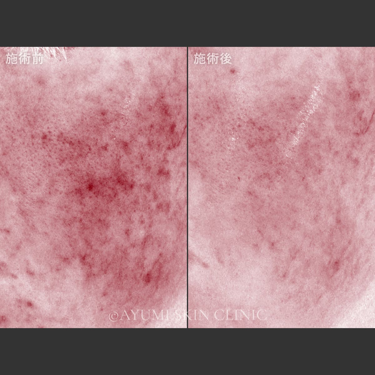 ピーリング＋スプレンダーフェイシャル　症例写真