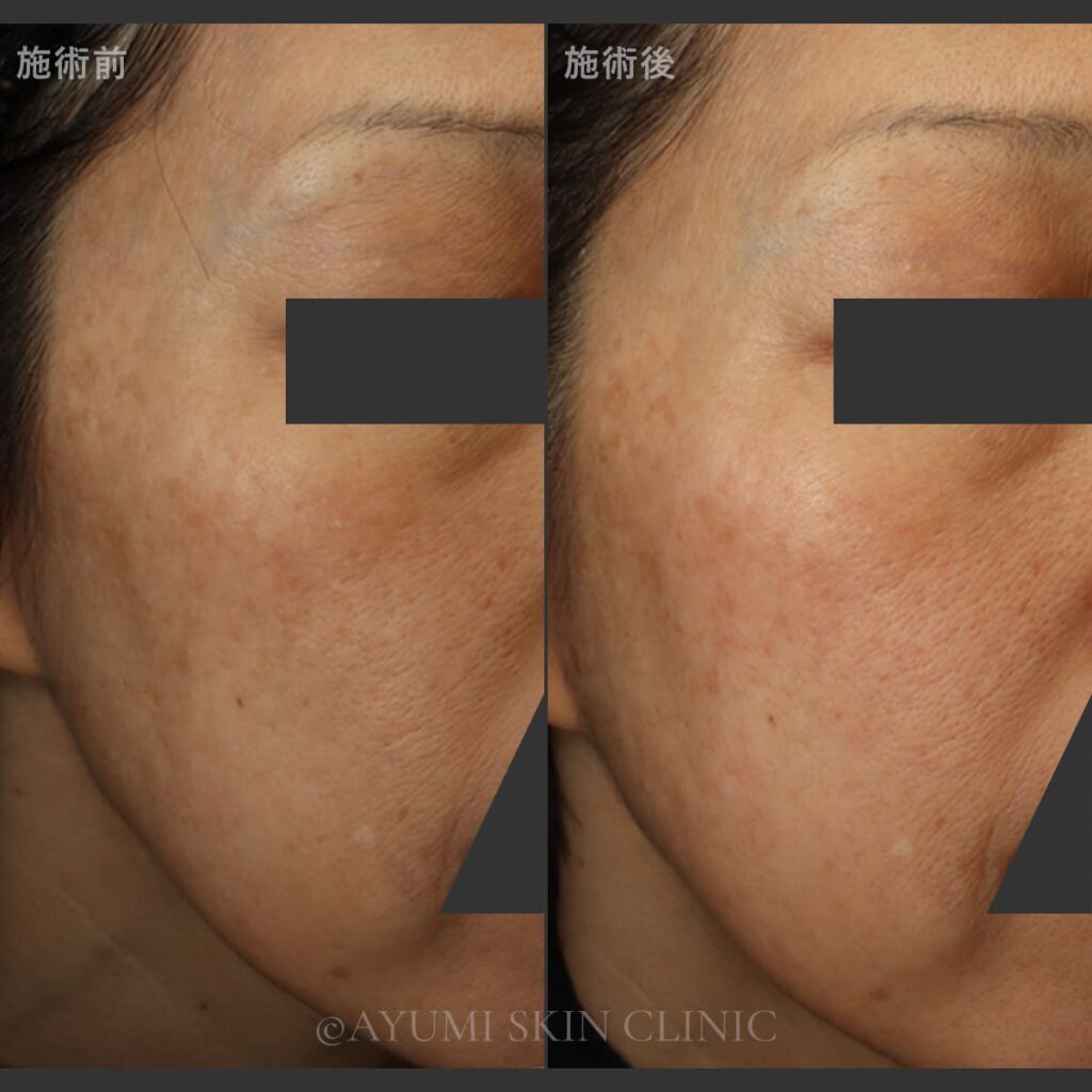 リバースピール　症例写真