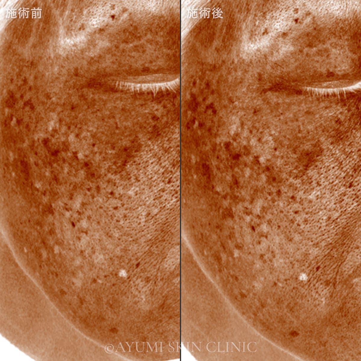 リバースピール　症例写真