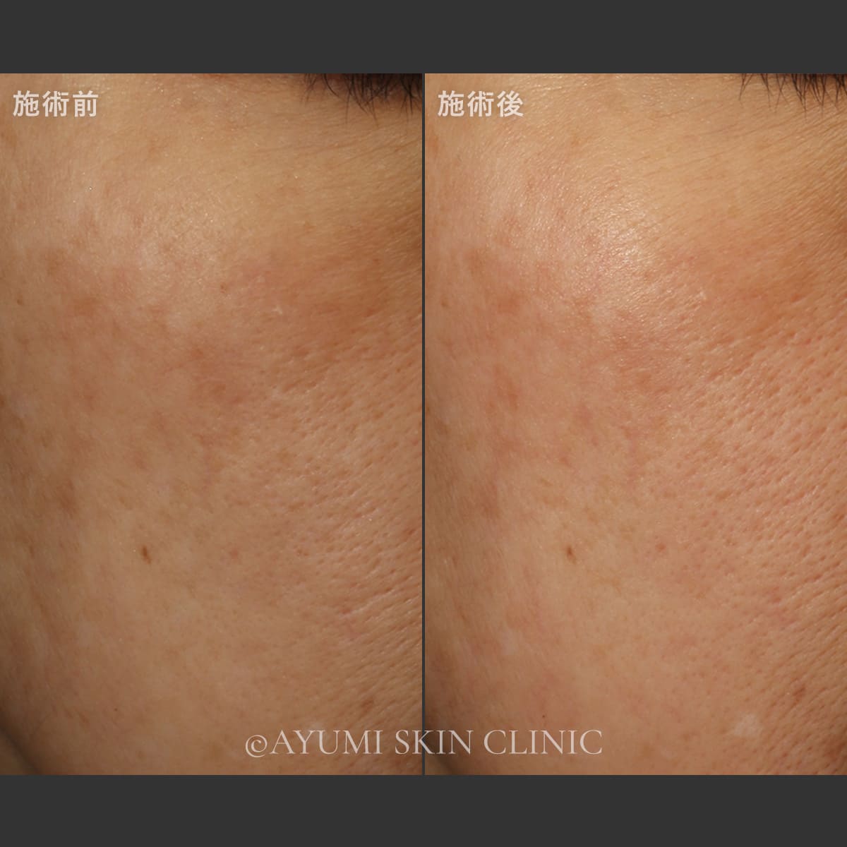 リバースピール　症例写真