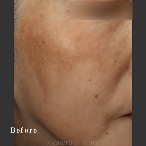 【シミ取り効果の症例】熊本の美容皮膚科 ｜赤み、くすみ｜AYUMI SKIN CLINIC