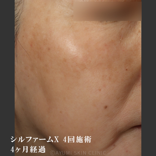 【シミ取り効果の症例】熊本の美容皮膚科 ｜赤み、くすみ｜AYUMI SKIN CLINIC
