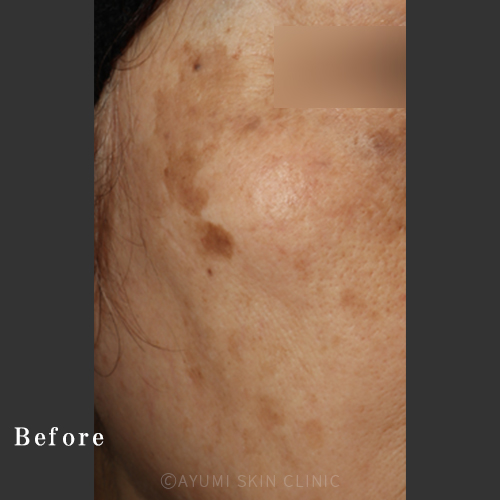 【シミ取り効果の症例】熊本の美容皮膚科 ｜シミ、あざ｜AYUMI SKIN CLINIC