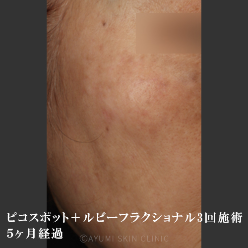 【シミ取り効果の症例】熊本の美容皮膚科 ｜シミ、あざ｜AYUMI SKIN CLINIC