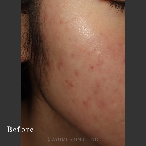 シミ取り効果の症例｜熊本の美容皮膚科｜ニキビ跡の色素沈着｜AYUMI SKIN CLINIC