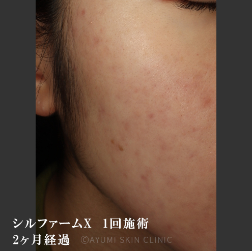 シミ取り効果の症例｜熊本の美容皮膚科｜ニキビ跡の色素沈着｜AYUMI SKIN CLINIC