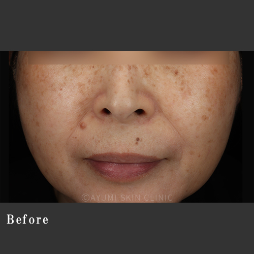 シミ取り効果の症例｜熊本の美容皮膚科｜広範囲の濃いシミ｜AYUMI SKIN CLINIC