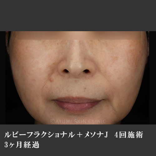 シミ取り効果の症例｜熊本の美容皮膚科｜広範囲の濃いシミ｜AYUMI SKIN CLINIC