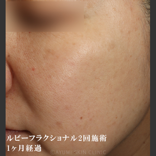 シミ取り効果の症例｜熊本の美容皮膚科｜薄く広がるシミ｜AYUMI SKIN CLINIC