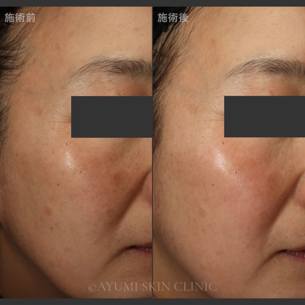 乳酸ピーリング＋メソナJ　症例写真