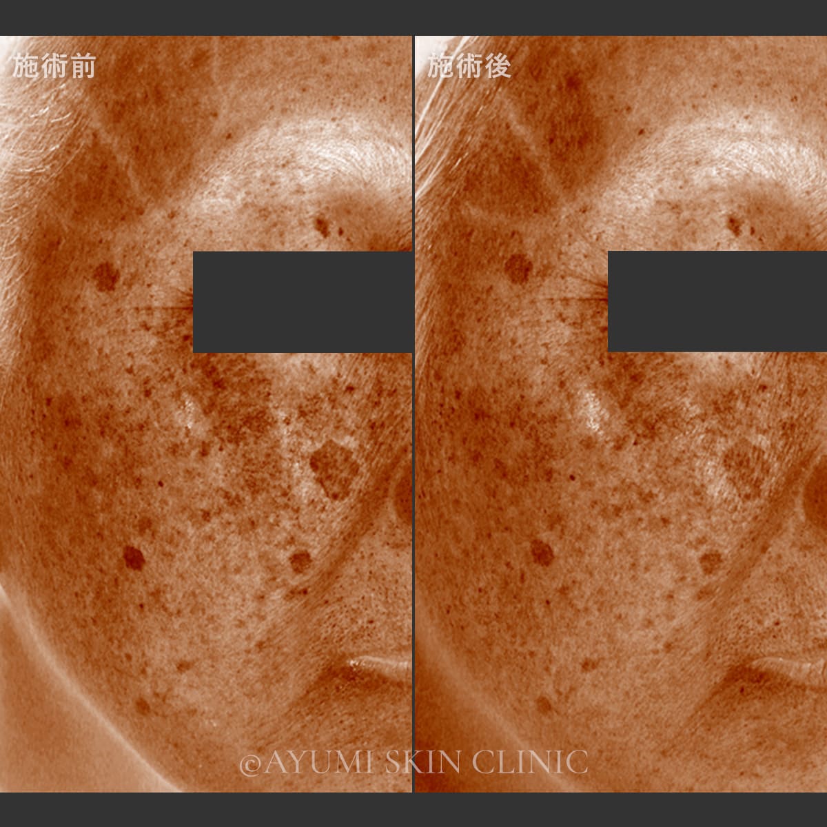 乳酸ピーリング＋メソナJ　症例写真