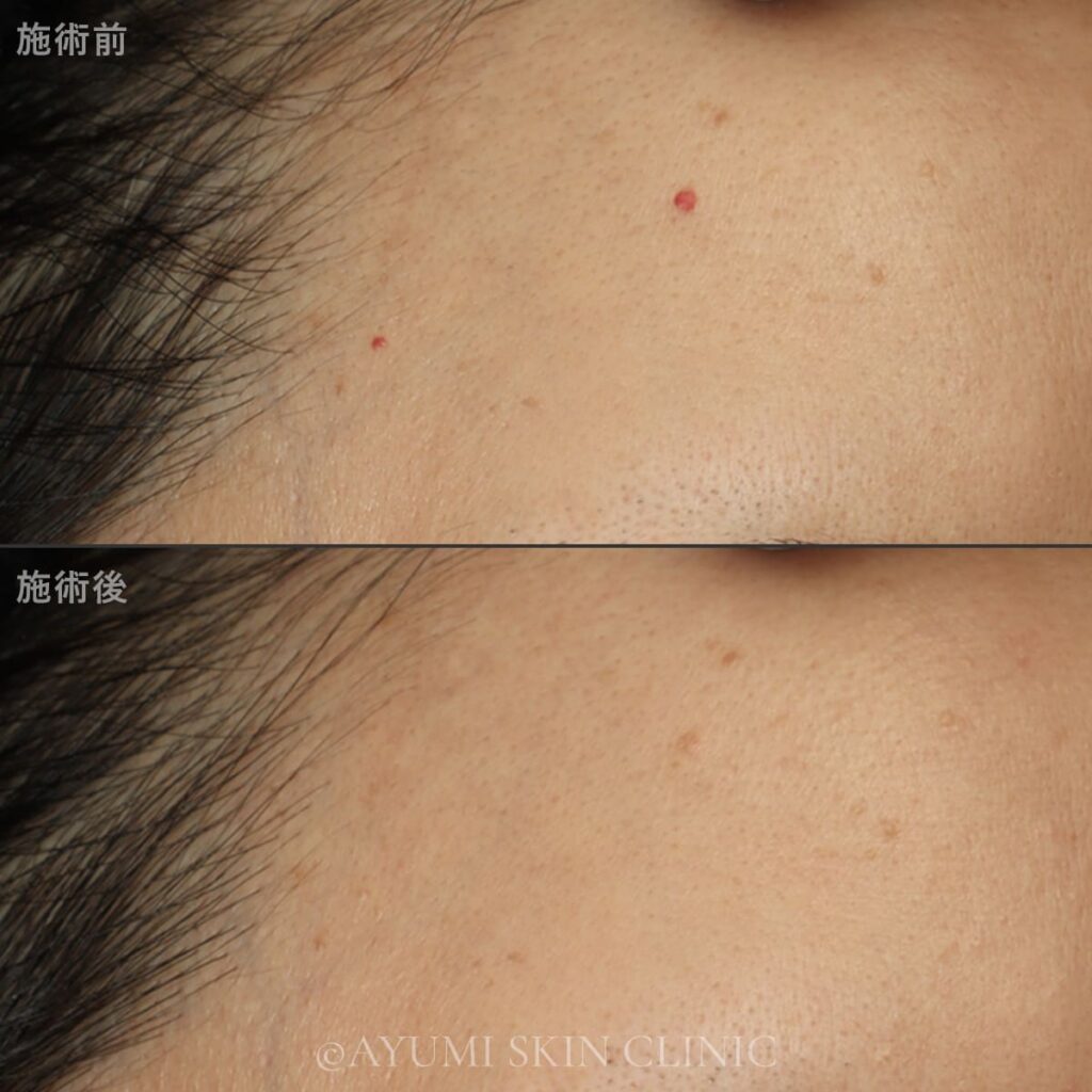 スプレンダーX YAGスポット　症例写真