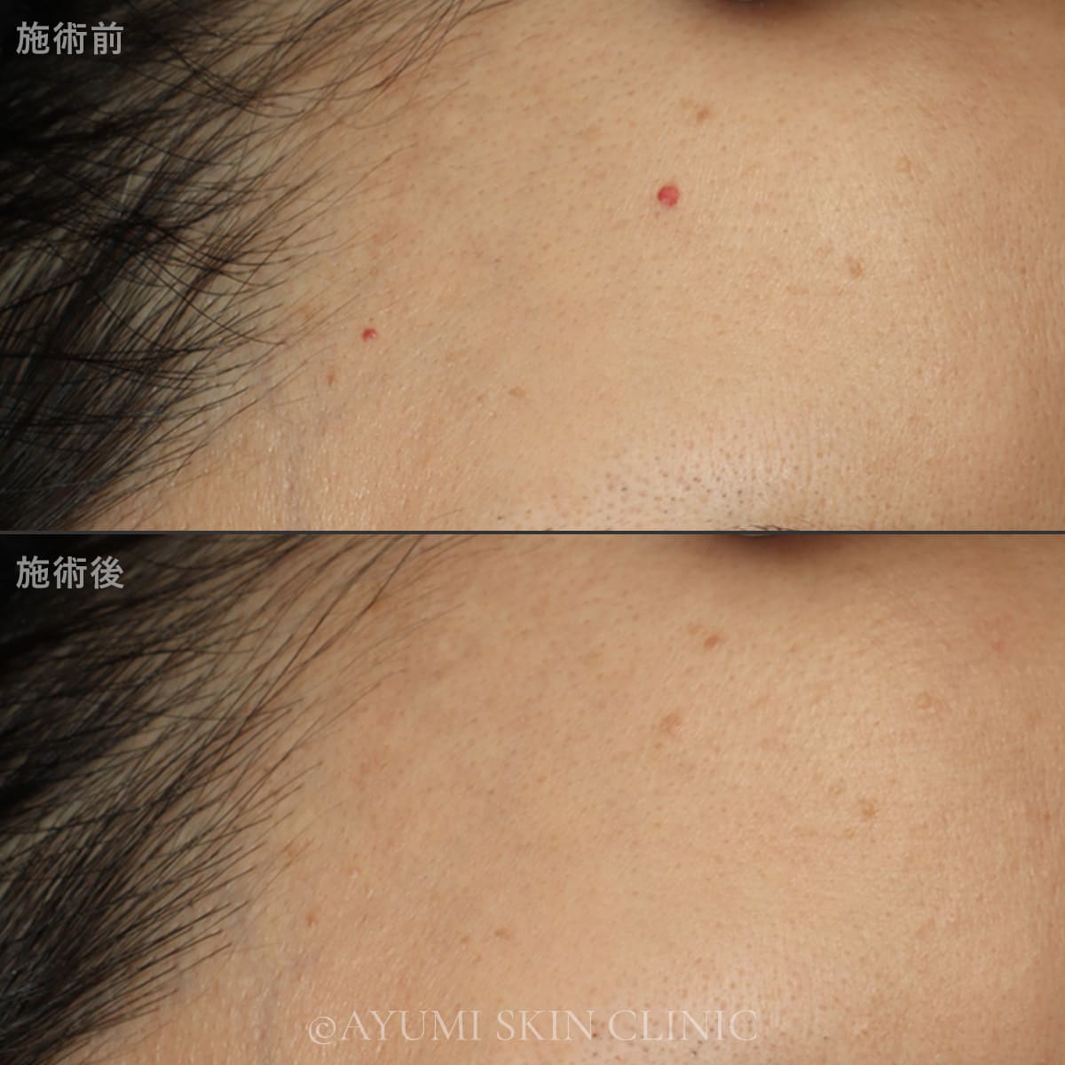 スプレンダーX YAGスポット 症例写真