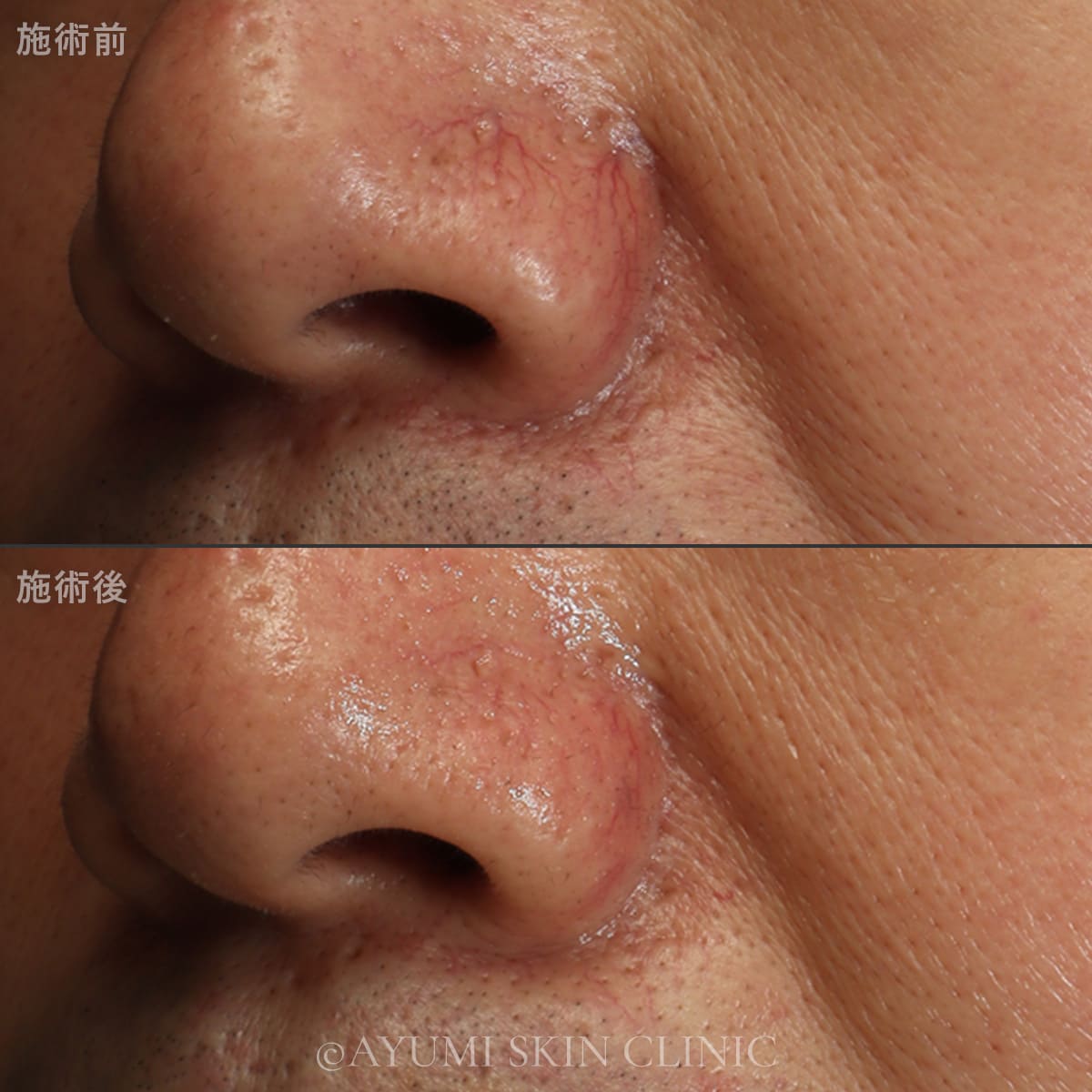 スプレンダーX YAGスポット 症例写真