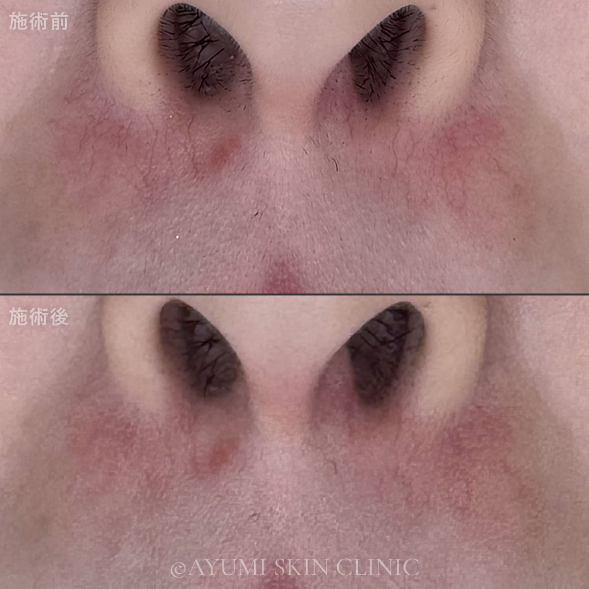 スプレンダーX YAGスポット 症例写真