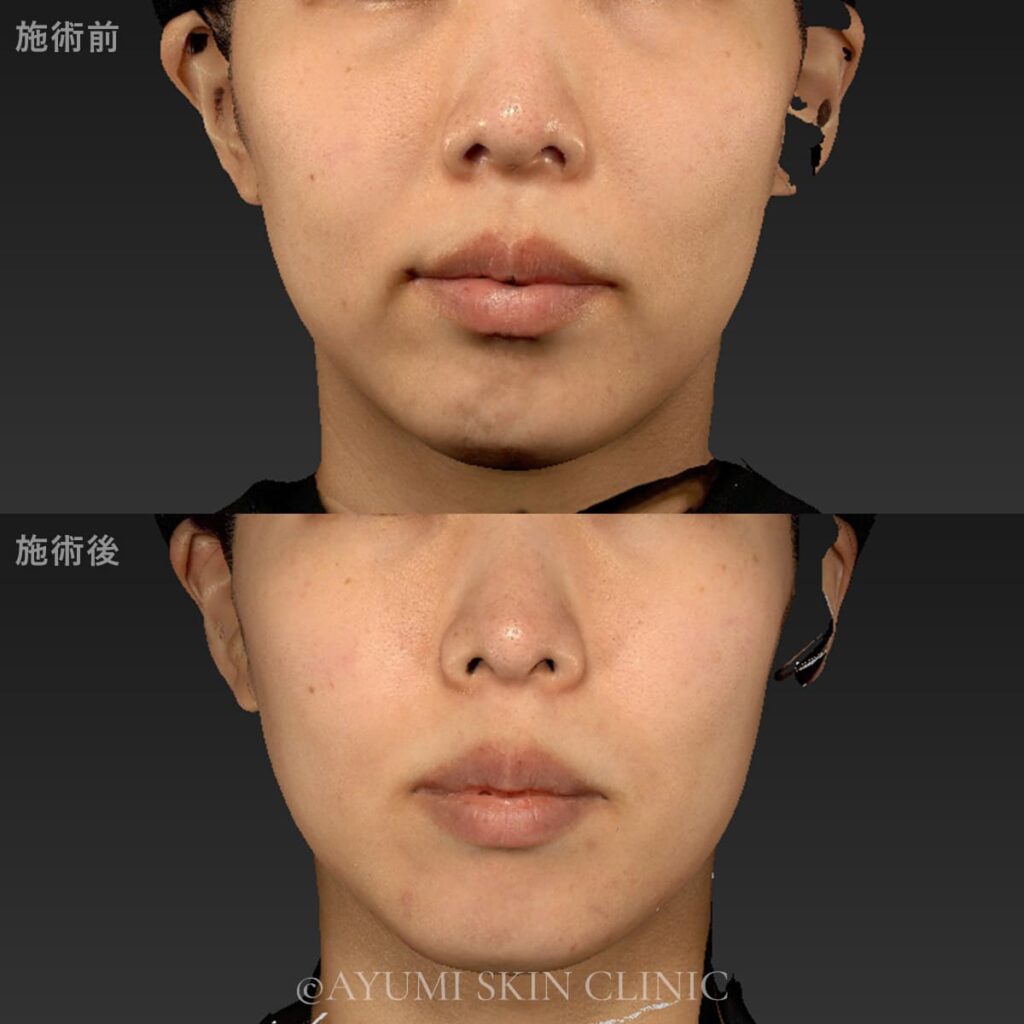 ボルニューマー　症例写真