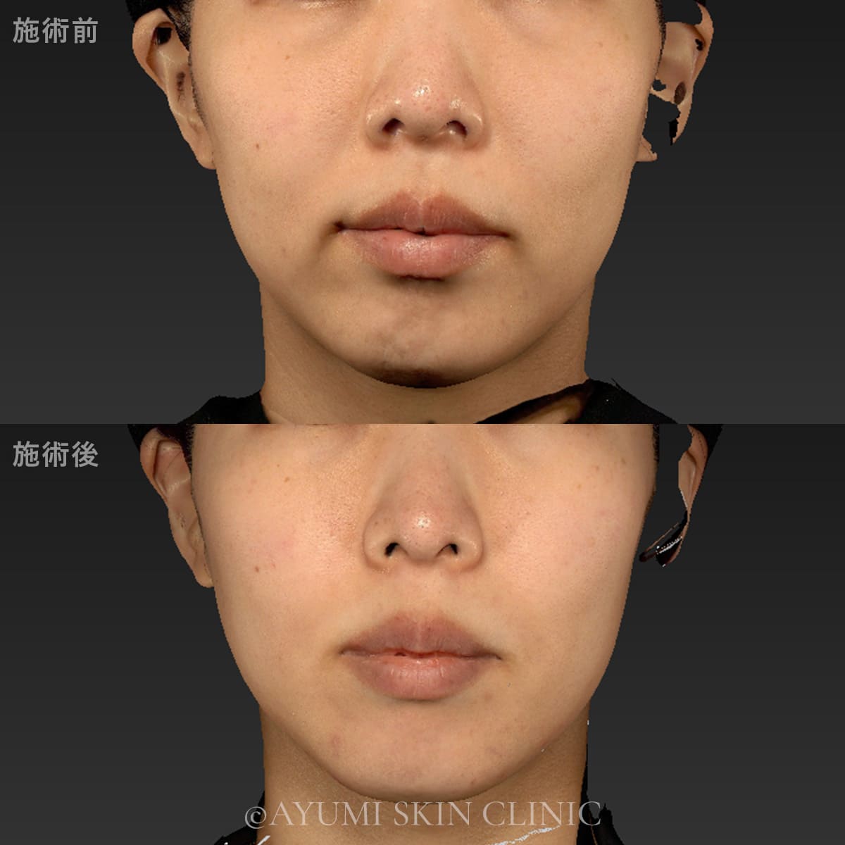 ボルニューマー　症例写真