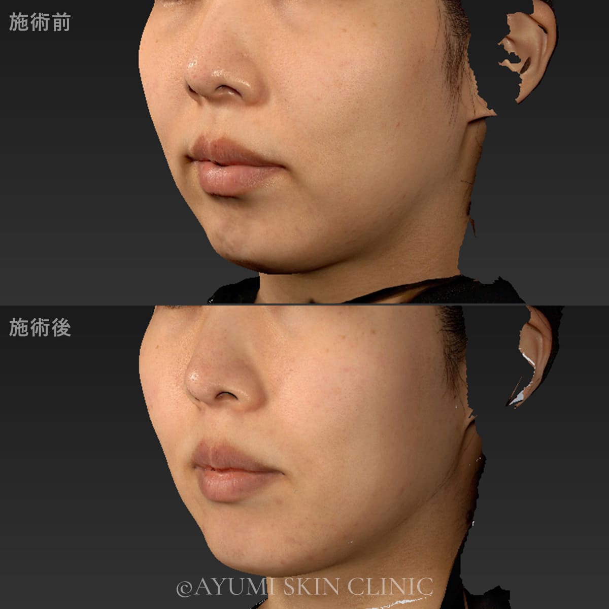 ボルニューマー　症例写真