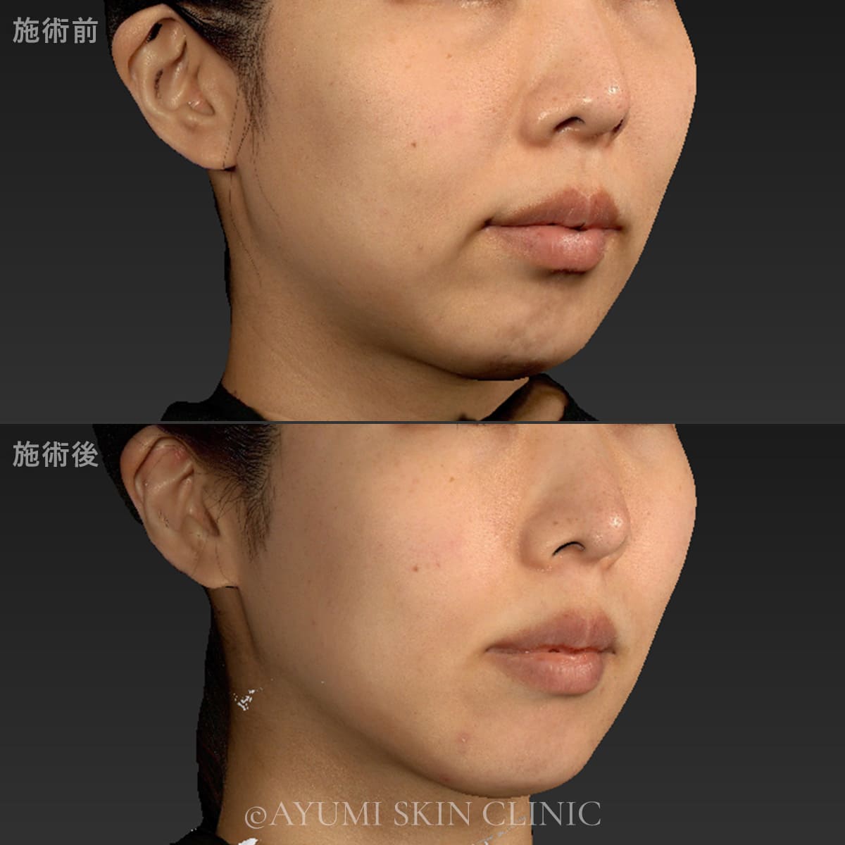 ボルニューマー　症例写真